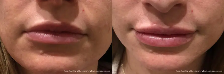 Lip Augmentation: Patient 9 - Before and After  