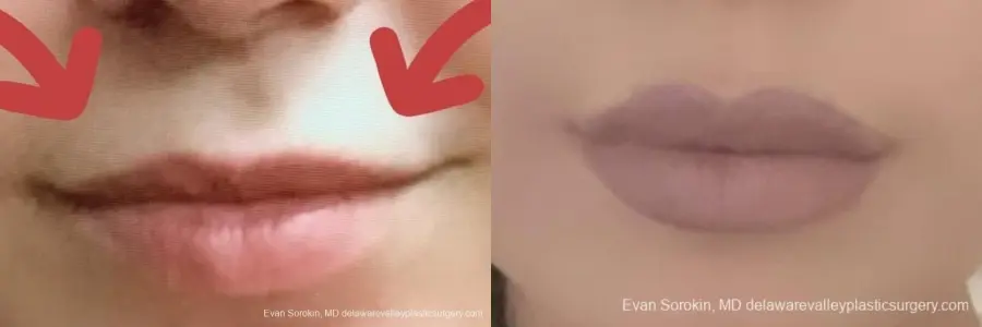 Lip Augmentation: Patient 4 - Before and After 2