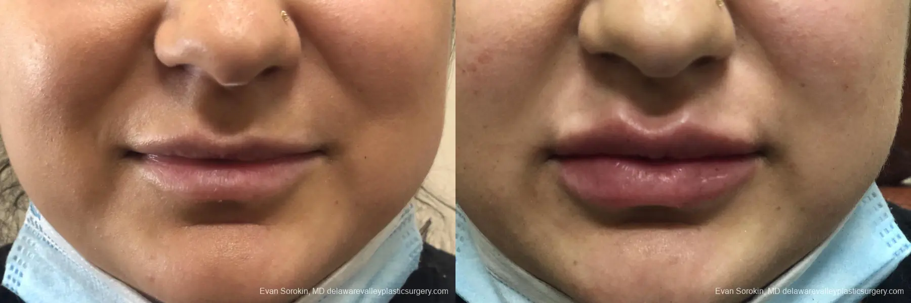 Lip Augmentation: Patient 33 - Before and After  