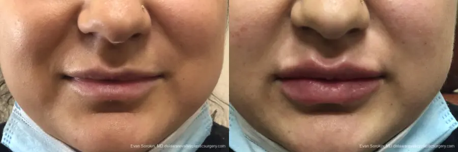 Lip Augmentation: Patient 33 - Before and After 1