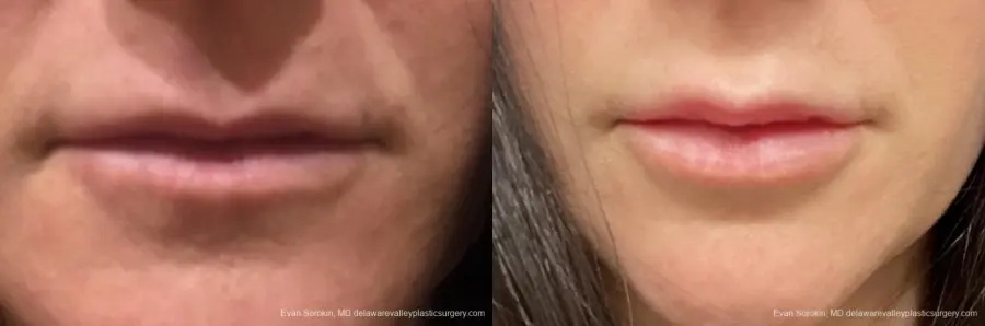 Lip Filler: Patient 4 - Before and After 1