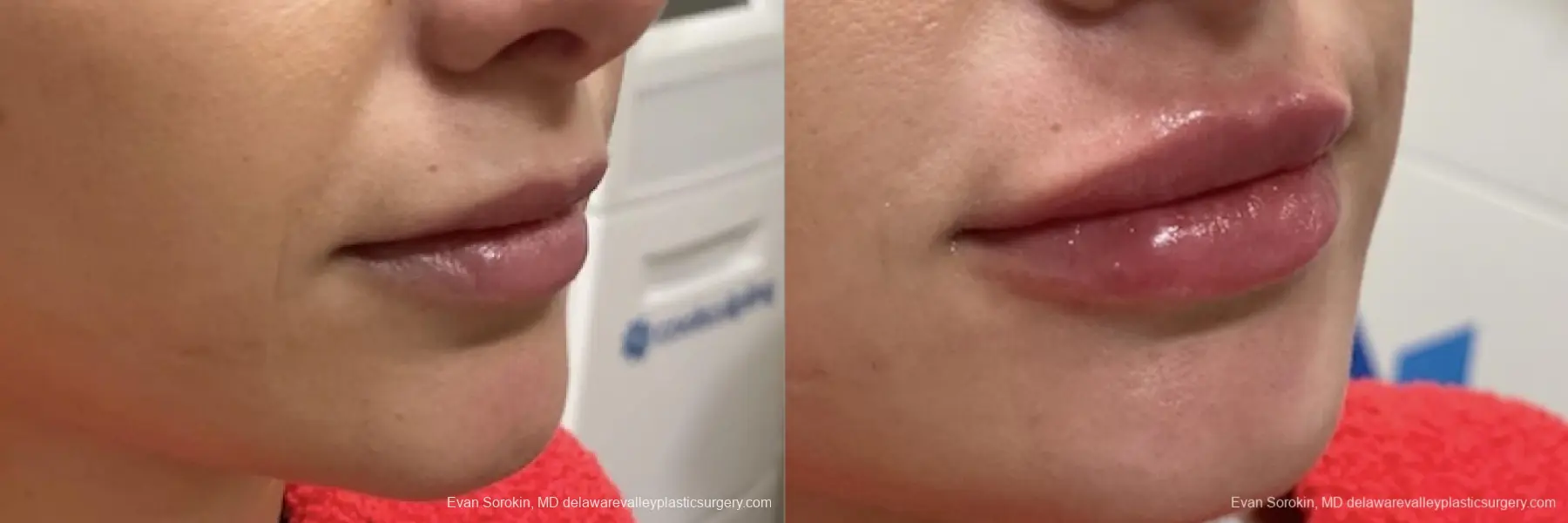 Lip Filler: Patient 42 - Before and After 1