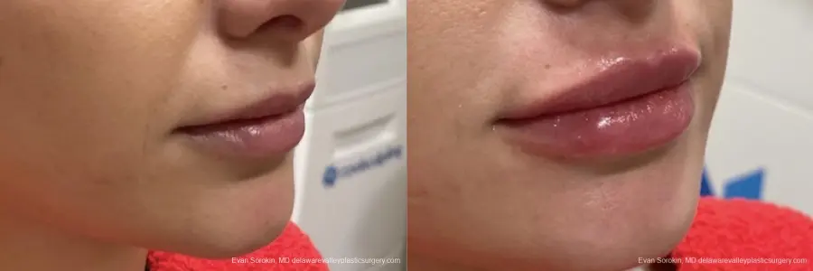 Lip Filler: Patient 7 - Before and After 1
