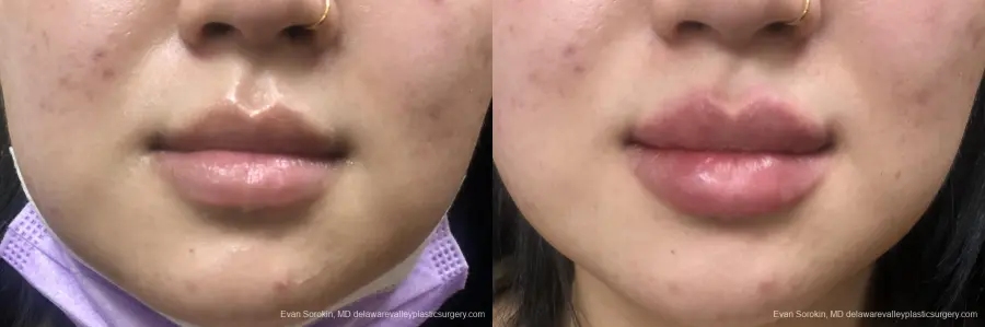 Lip Filler: Patient 9 - Before and After 1