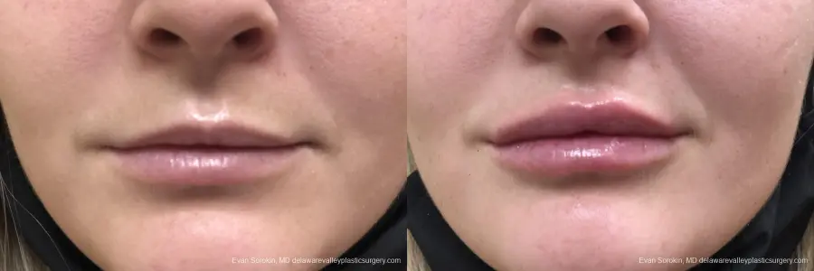 Lip Filler: Patient 5 - Before and After 1