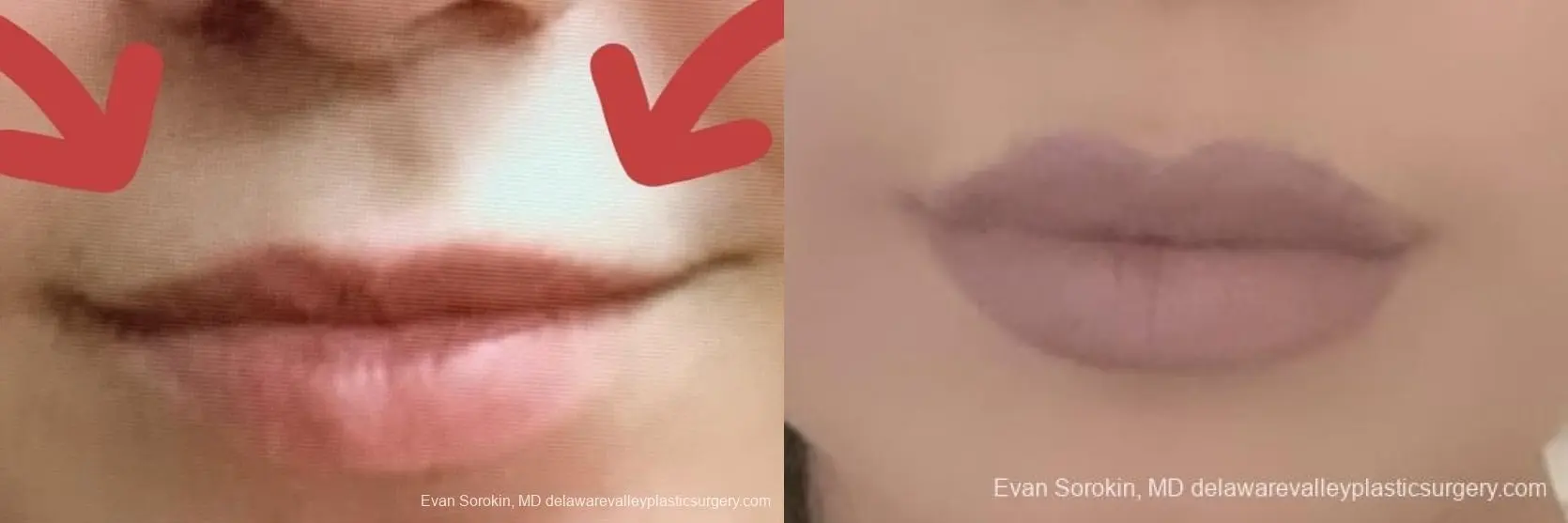 Lip Filler: Patient 44 - Before and After 2