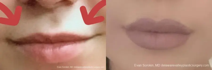 Lip Filler: Patient 9 - Before and After 2