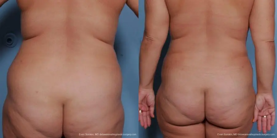 Philadelphia Liposuction 9481 - Before and After 4