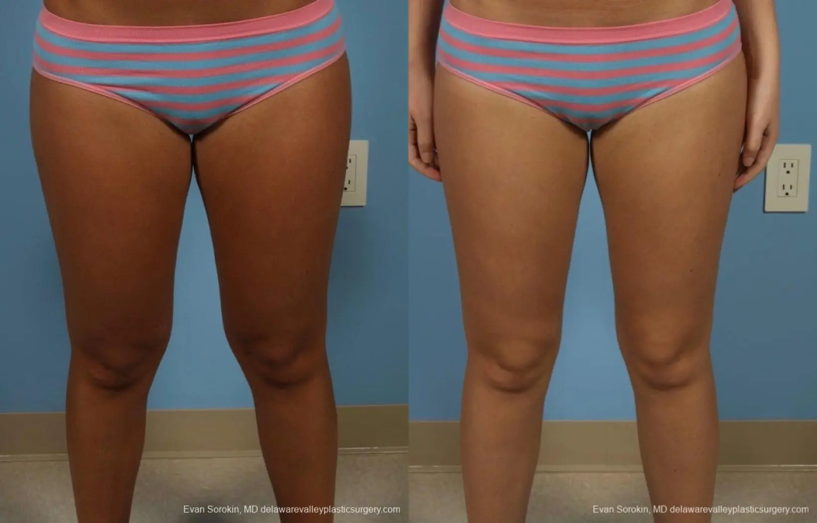 Philadelphia Liposuction 8794 - Before and After 1