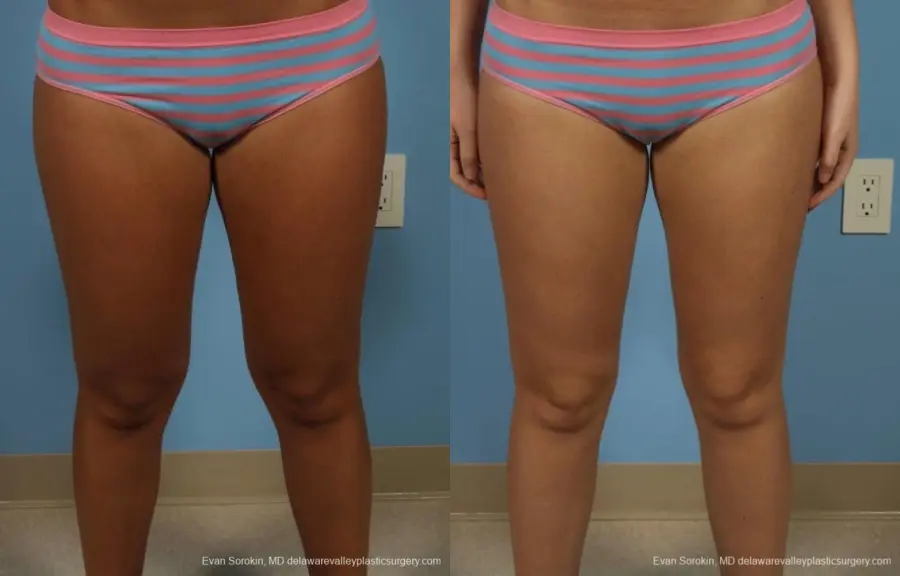 Philadelphia Liposuction 8794 - Before and After