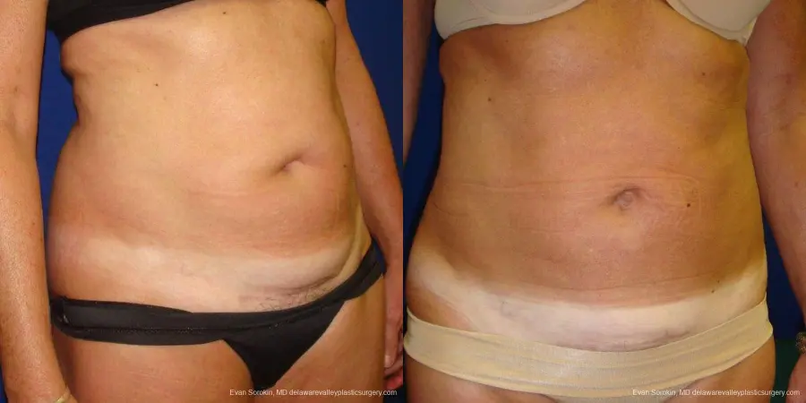 Philadelphia Liposuction 9488 - Before and After 4