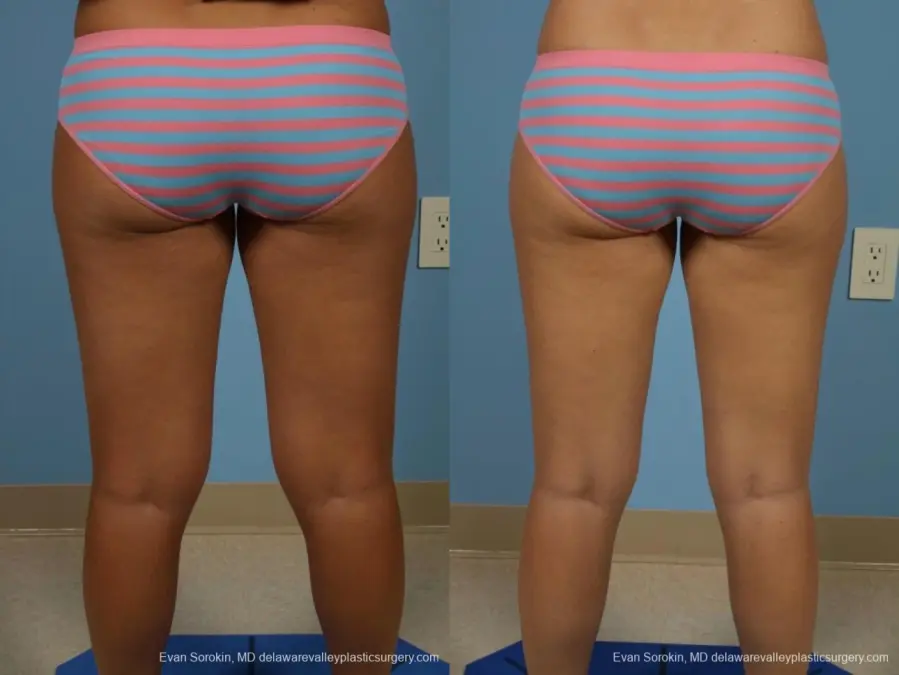 Philadelphia Liposuction 8794 - Before and After 5