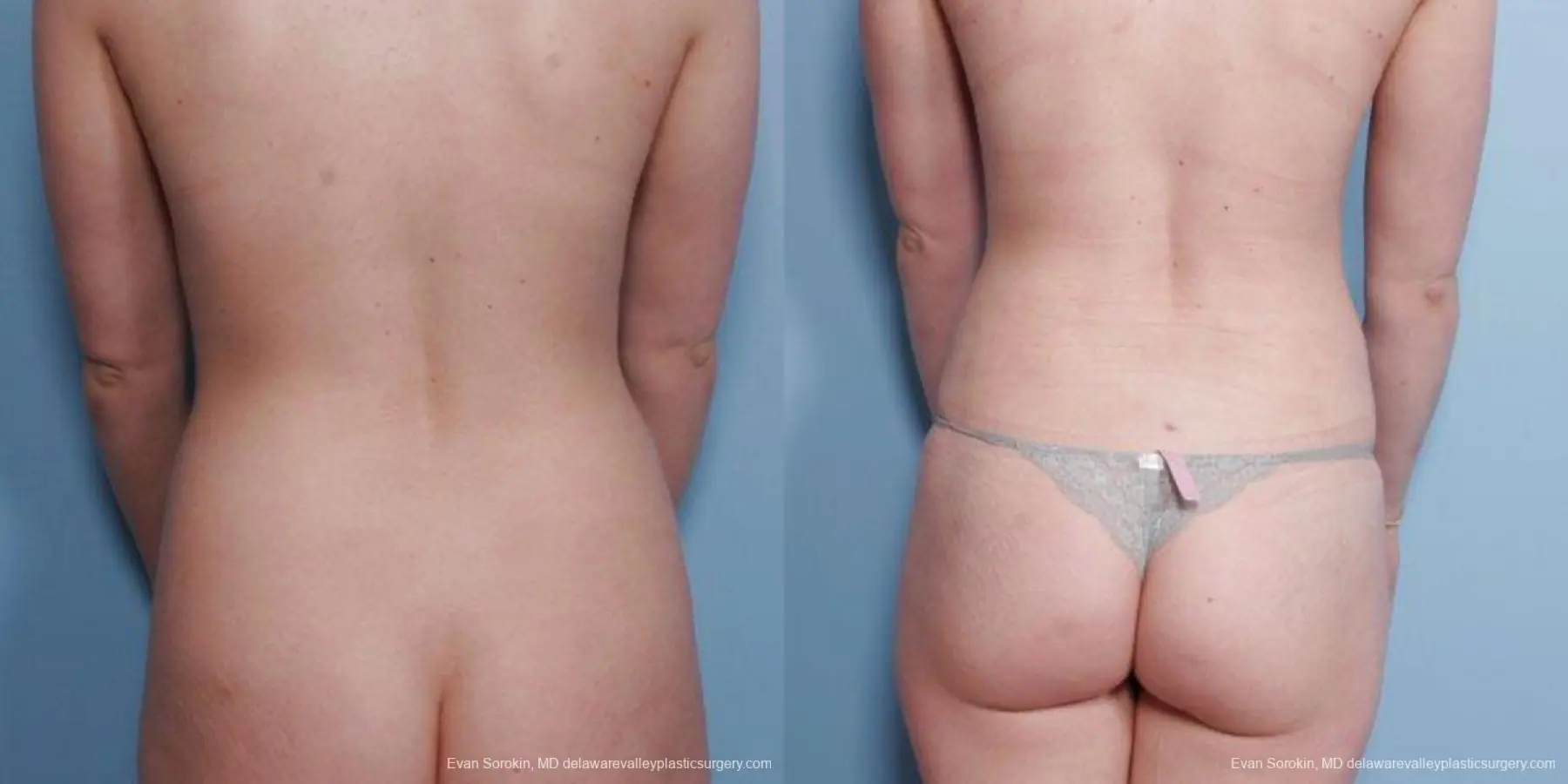Philadelphia Liposuction 9482 - Before and After 5