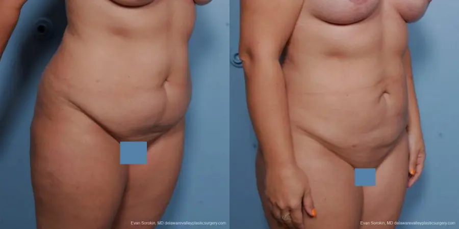 Philadelphia Liposuction 9481 - Before and After 2