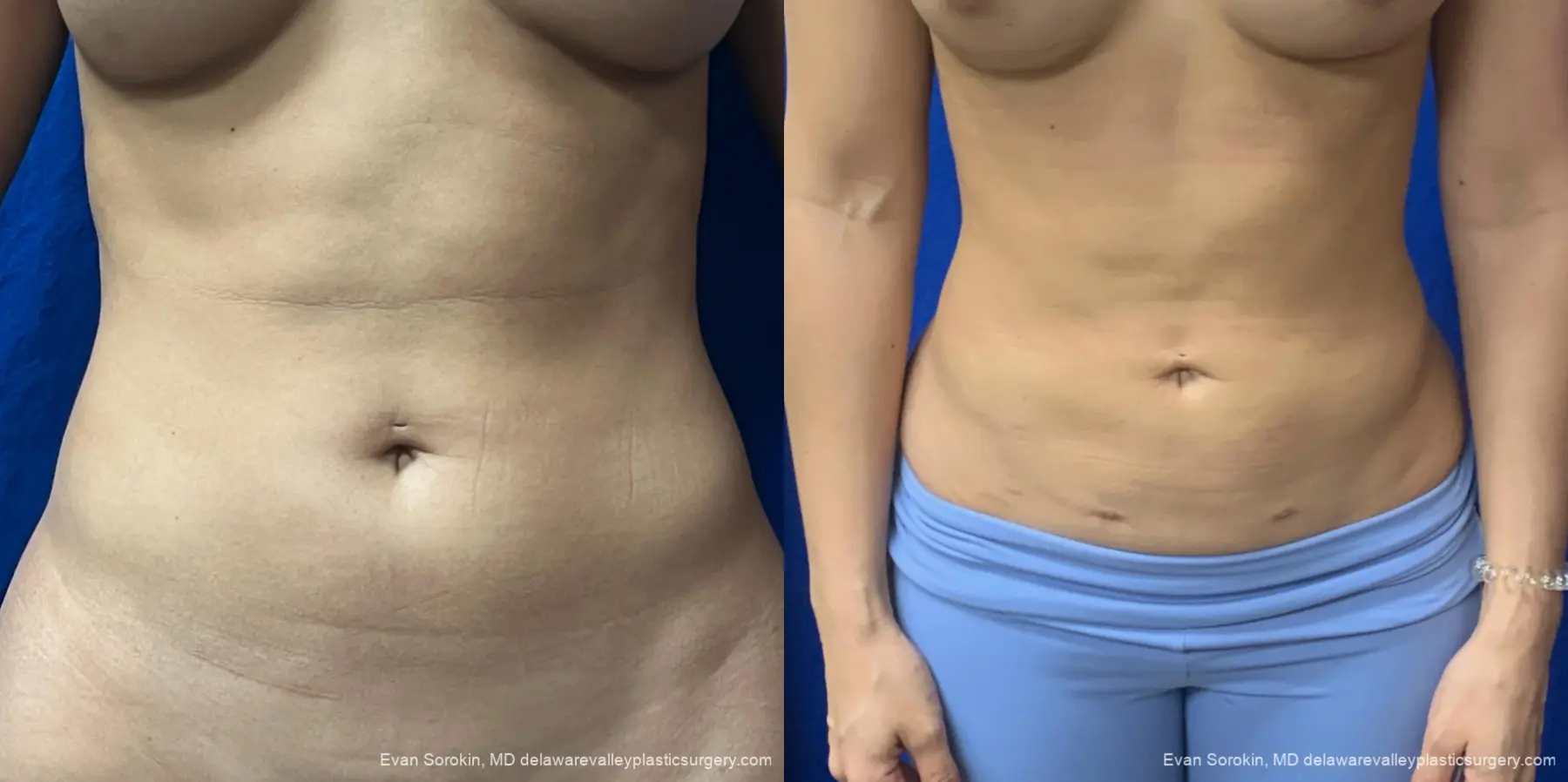 Liposuction: Patient 11 - Before and After