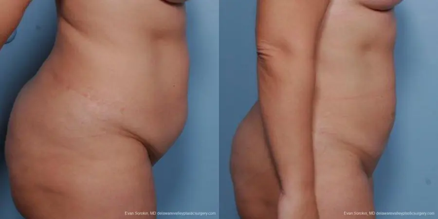 Philadelphia Liposuction 9481 - Before and After 3