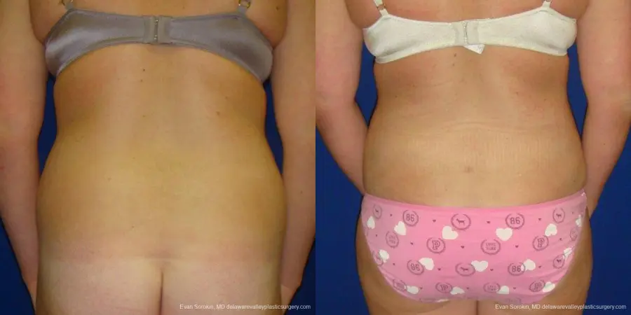 Philadelphia Liposuction 9484 - Before and After 5