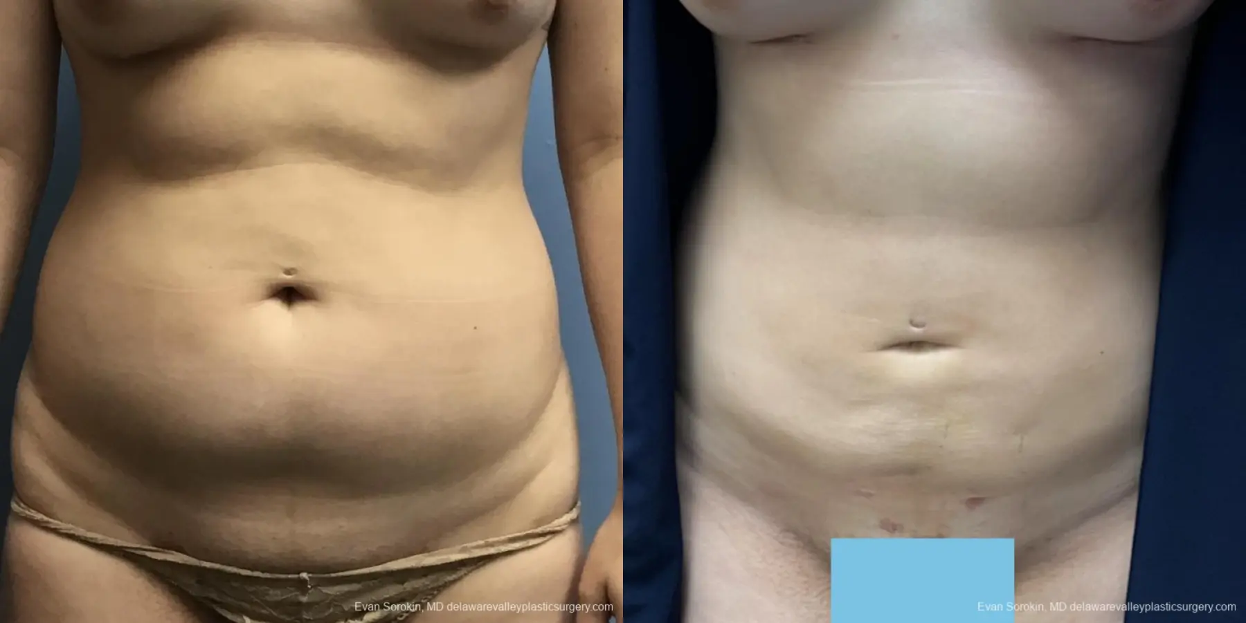 Liposuction: Patient 9 - Before and After  