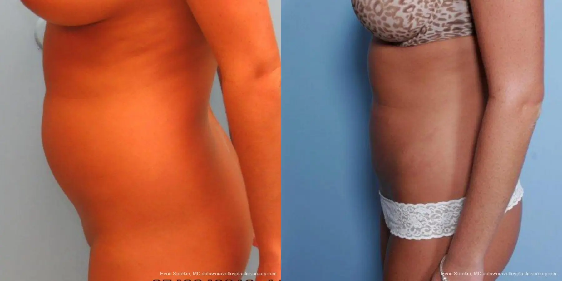 Philadelphia Liposuction 9483 - Before and After 3