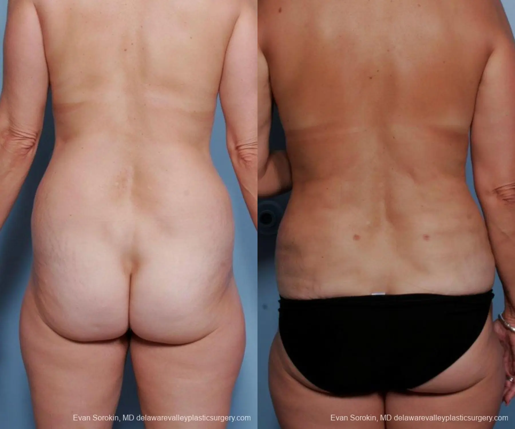 Philadelphia Liposuction 9374 - Before and After