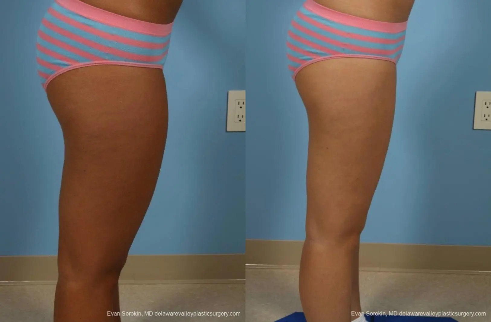 Philadelphia Liposuction 8794 - Before and After 3