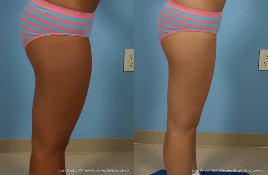 Philadelphia Liposuction 8794 - Before and After 3