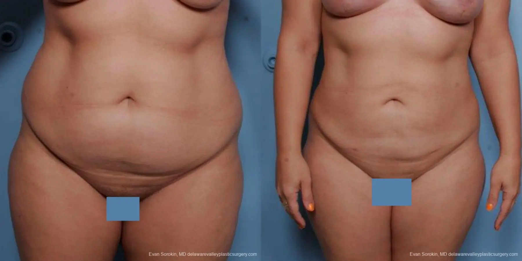 Philadelphia Liposuction 9481 - Before and After