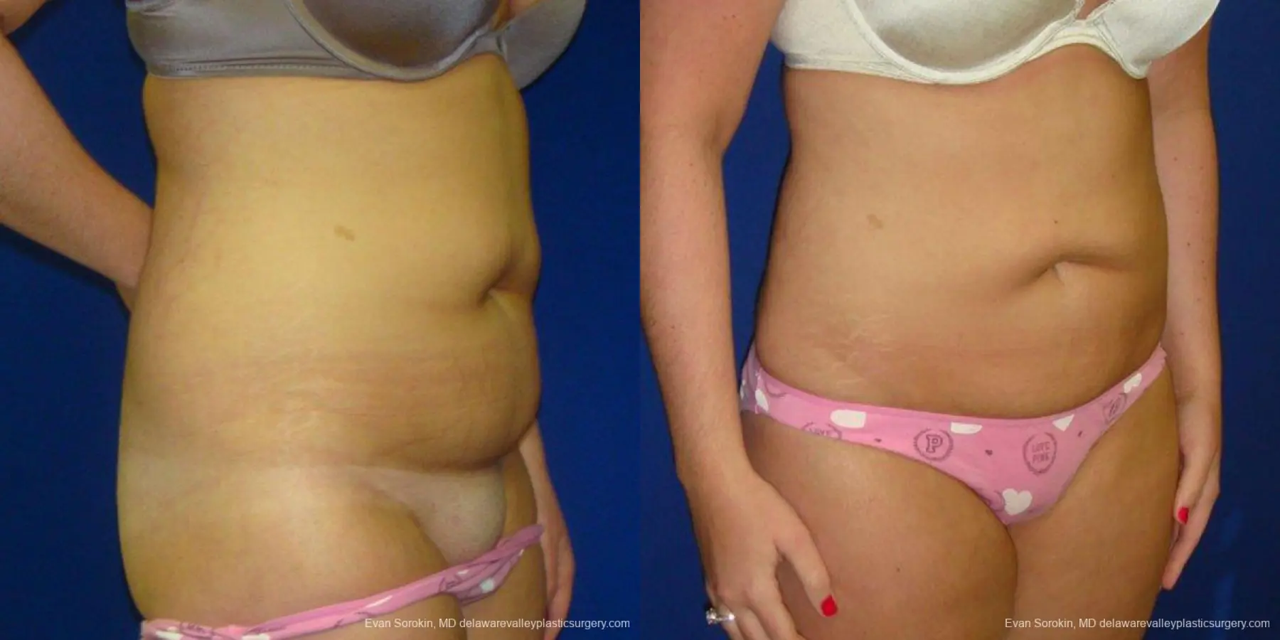 Philadelphia Liposuction 9484 - Before and After 2