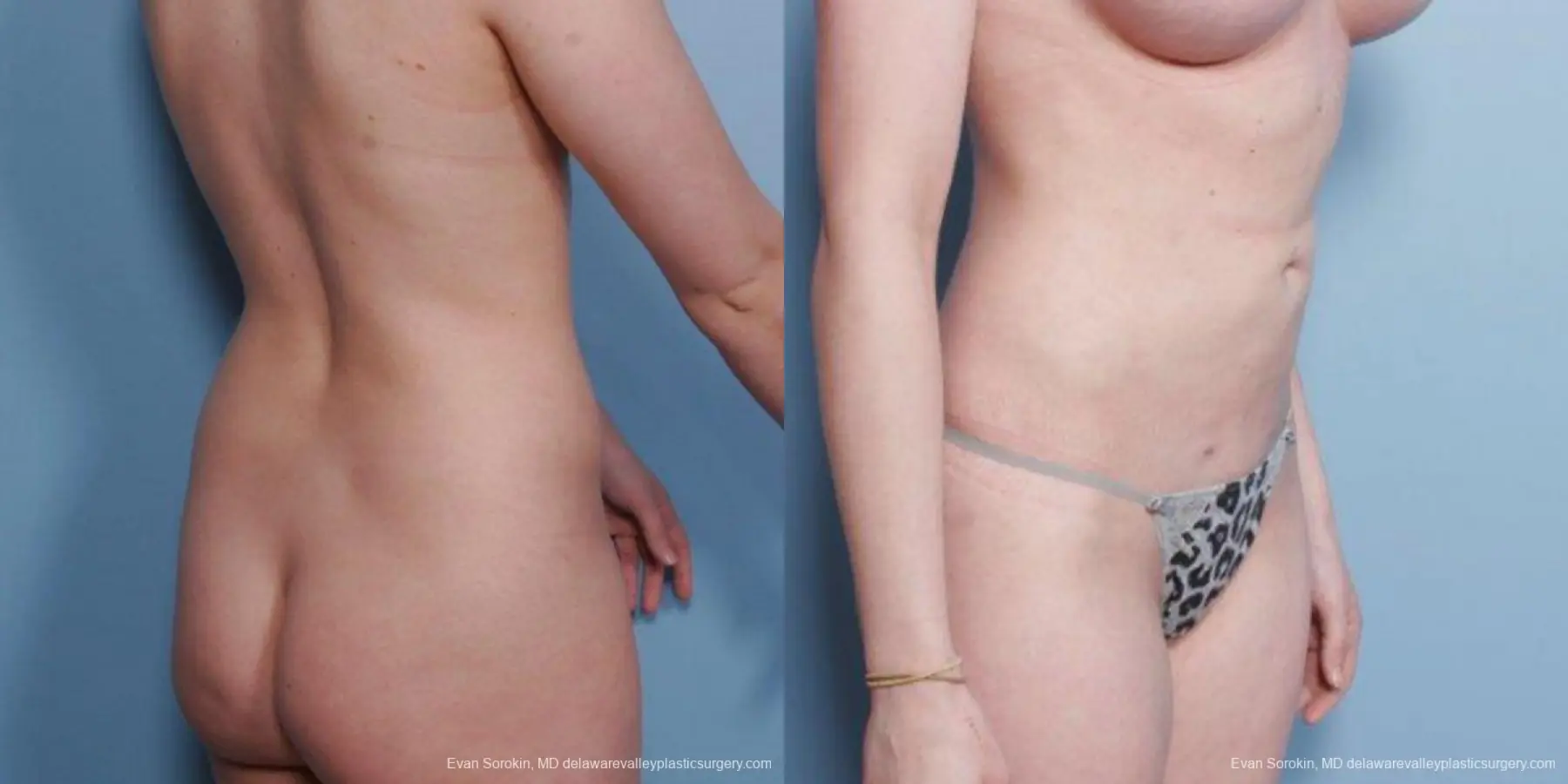 Philadelphia Liposuction 9482 - Before and After 2