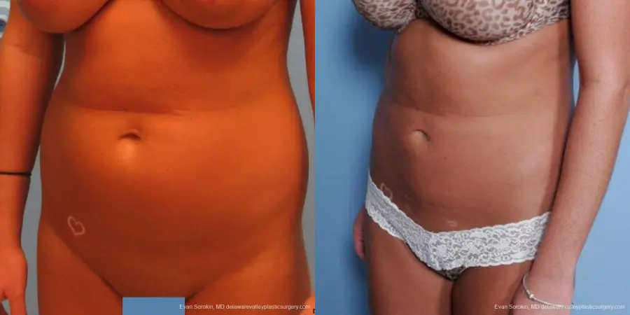 Philadelphia Liposuction 9483 - Before and After 2