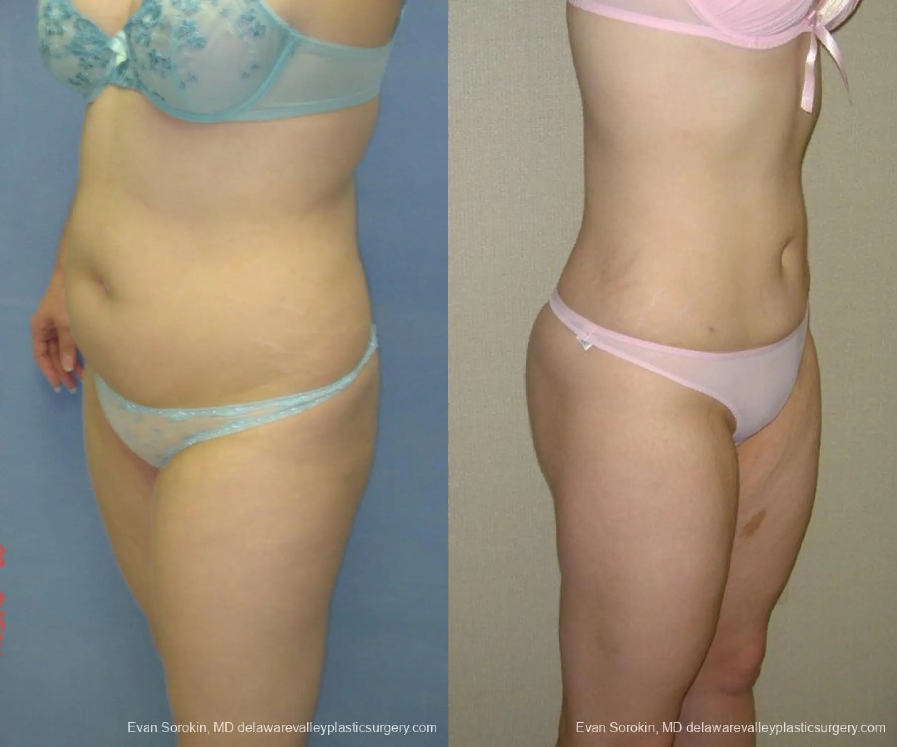 Philadelphia Liposuction 9480 - Before and After 2