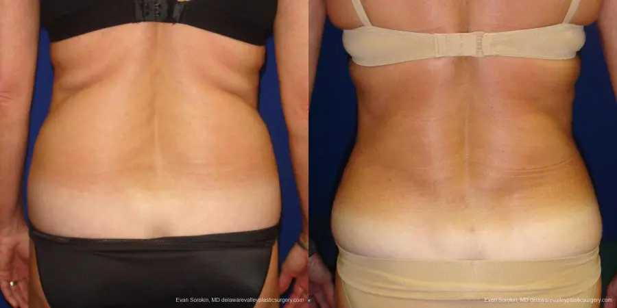 Philadelphia Liposuction 9488 - Before and After 5