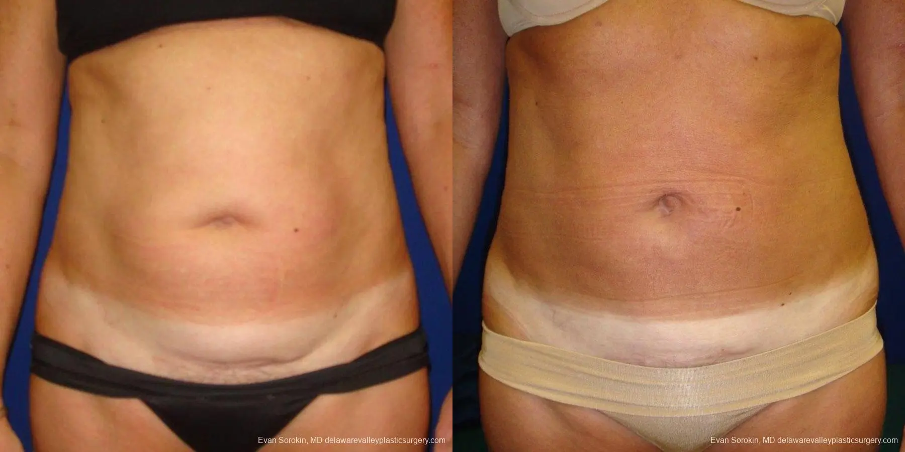 Philadelphia Liposuction 9488 - Before and After