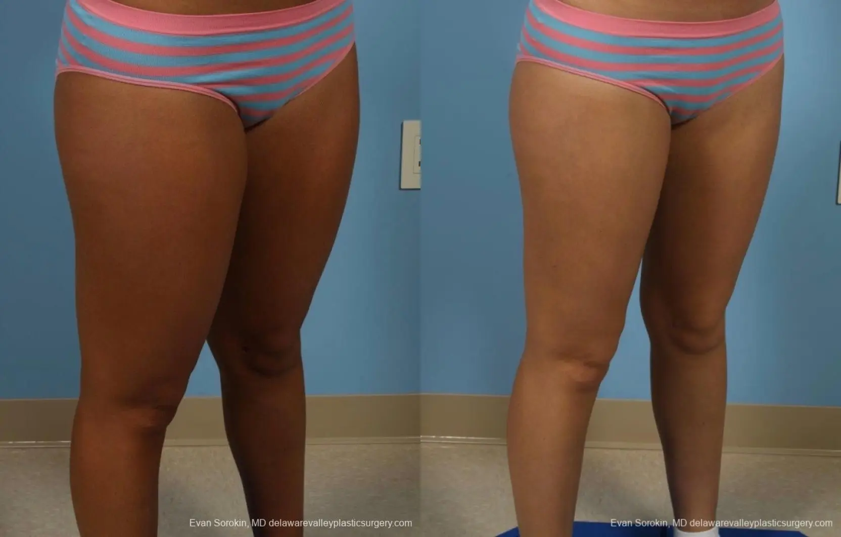 Philadelphia Liposuction 8794 - Before and After 2