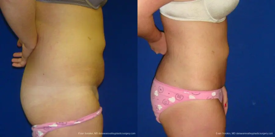 Philadelphia Liposuction 9484 - Before and After 4