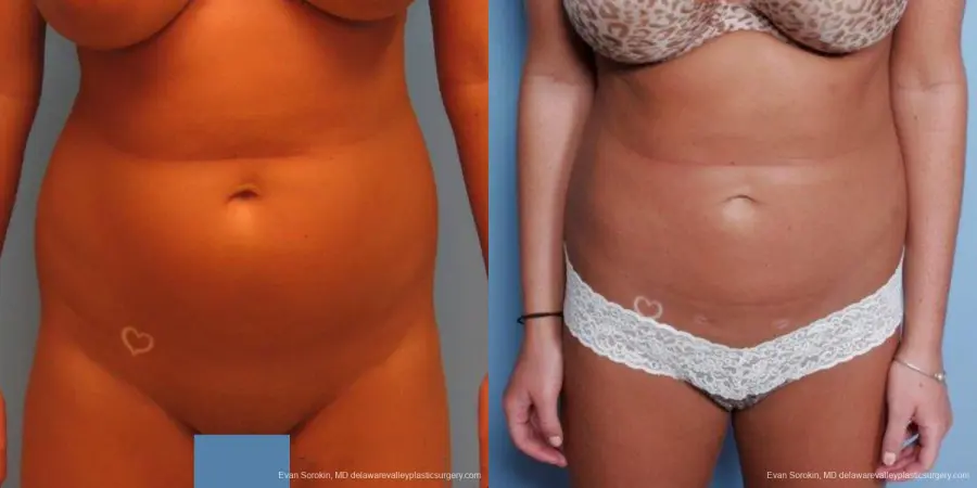 Philadelphia Liposuction 9483 - Before and After 1