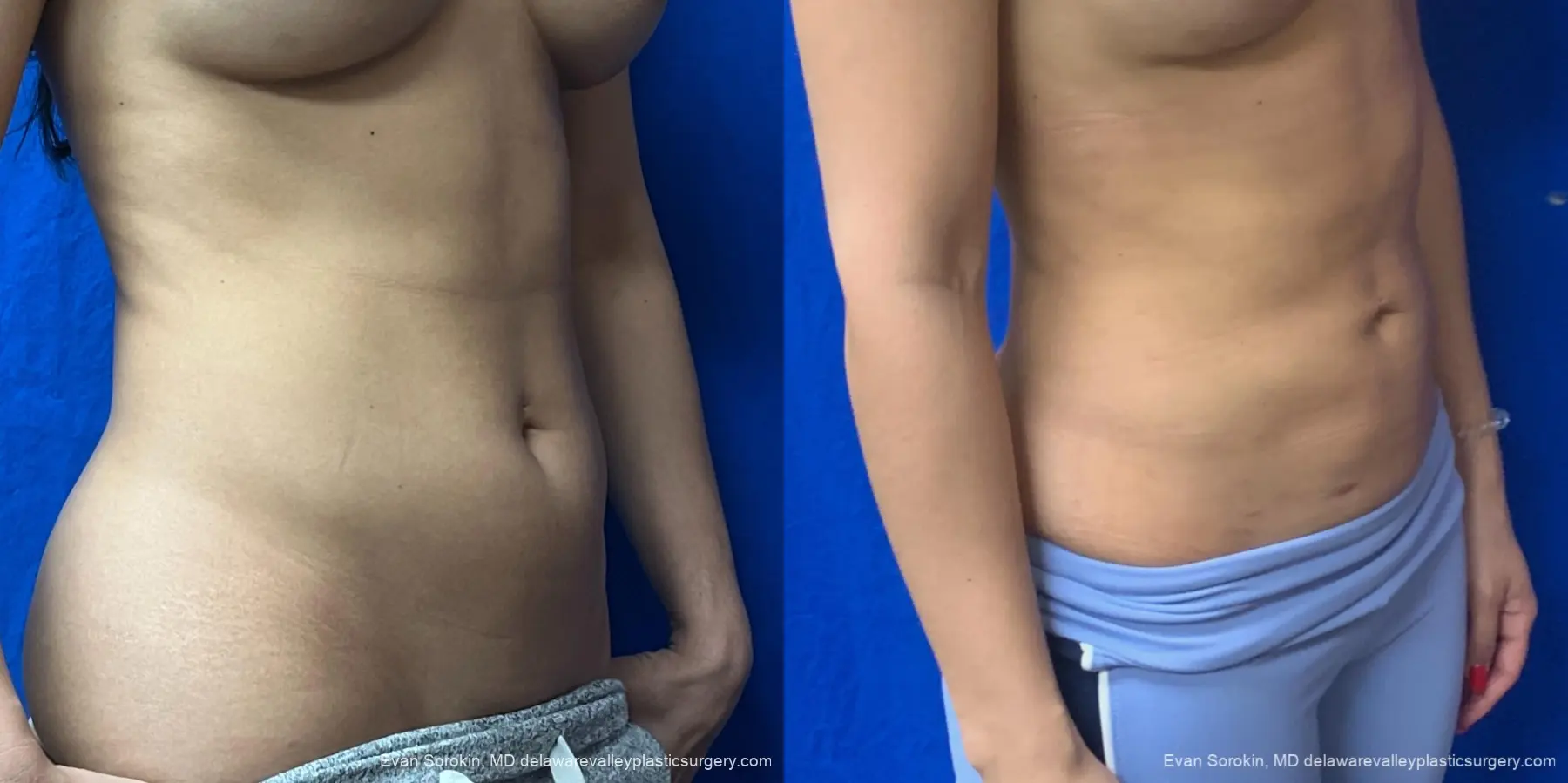 Liposuction: Patient 11 - Before and After 2