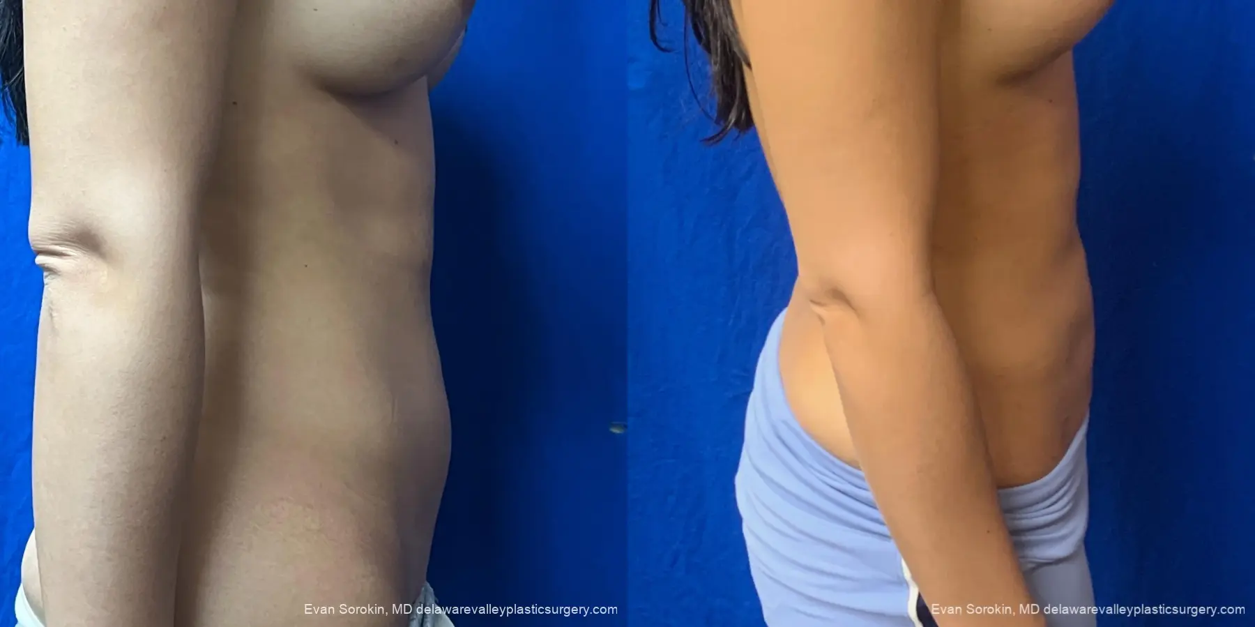 Liposuction: Patient 11 - Before and After 4