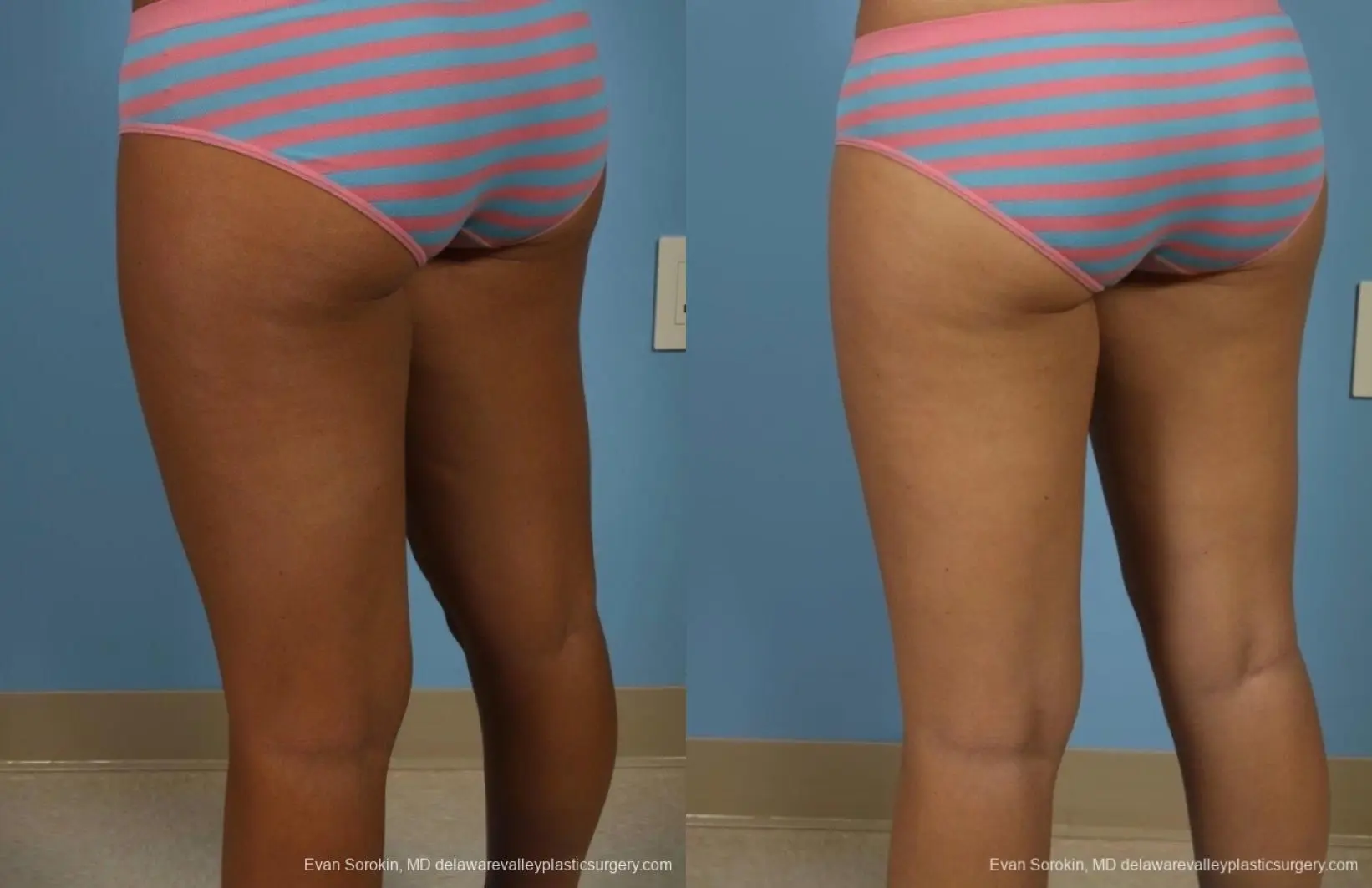 Philadelphia Liposuction 8794 - Before and After 4