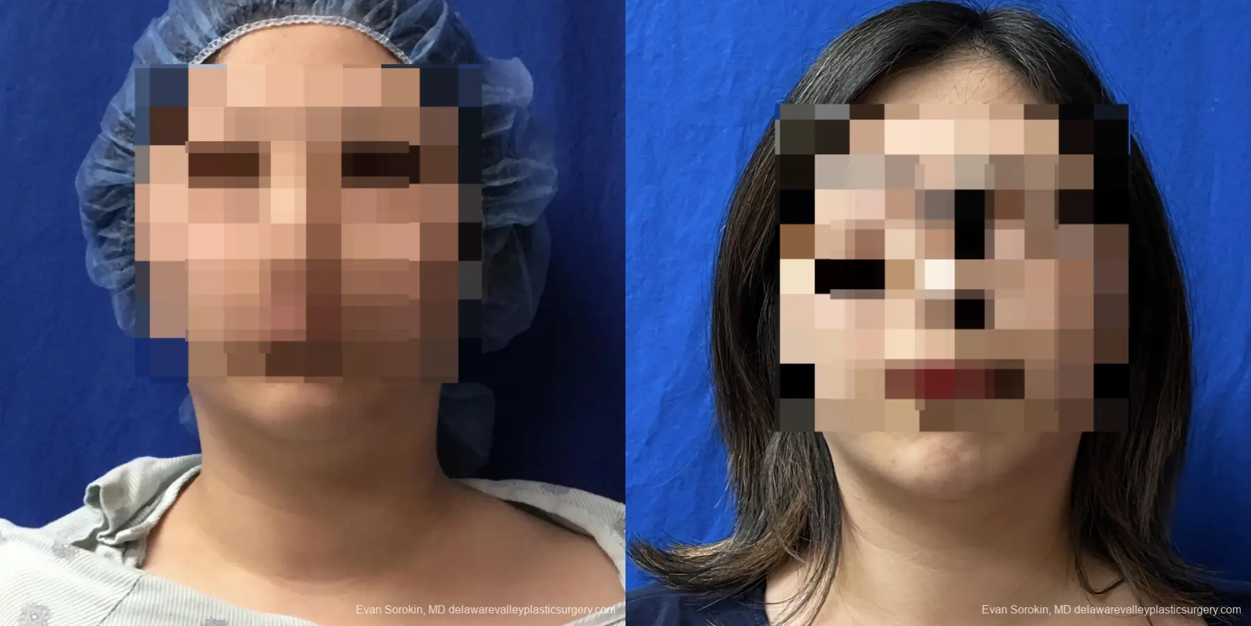 Liposuction: Patient 10 - Before and After  