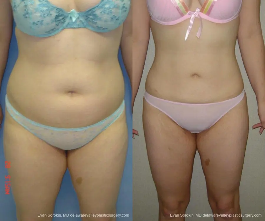 Philadelphia Liposuction 9480 - Before and After