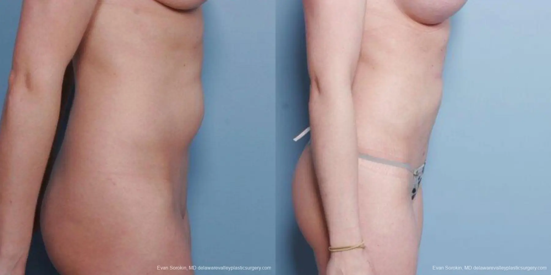 Philadelphia Liposuction 9482 - Before and After 3