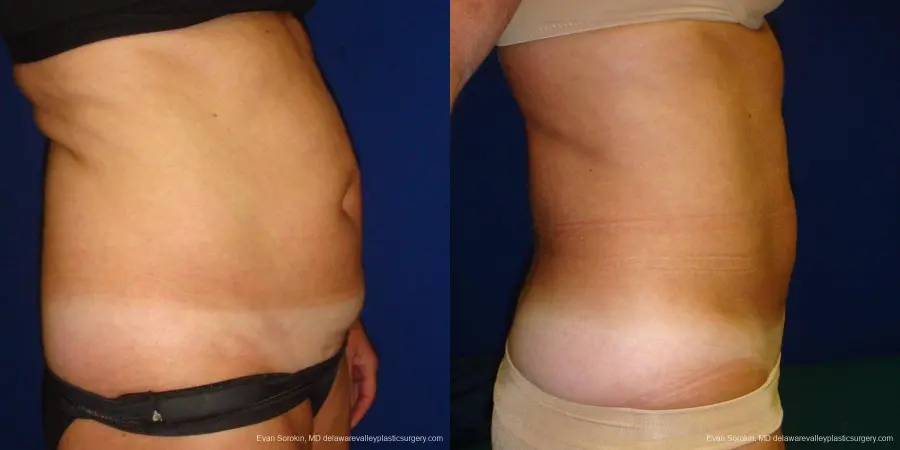 Philadelphia Liposuction 9488 - Before and After 3