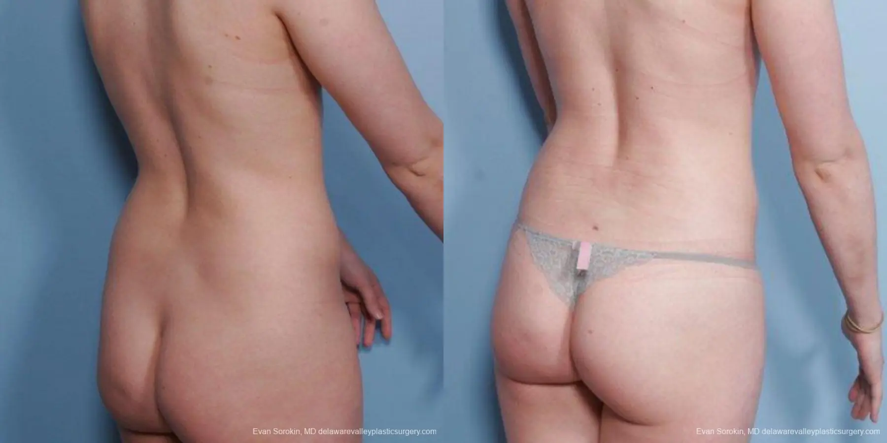 Philadelphia Liposuction 9482 - Before and After 4
