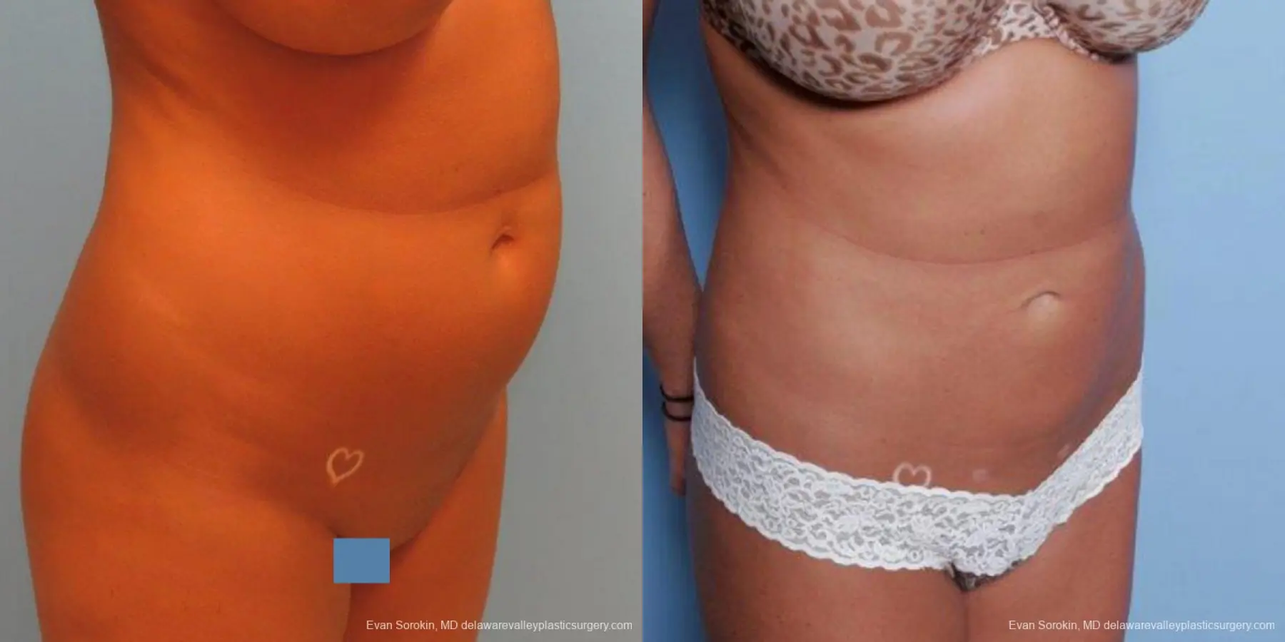 Philadelphia Liposuction 9483 - Before and After 4