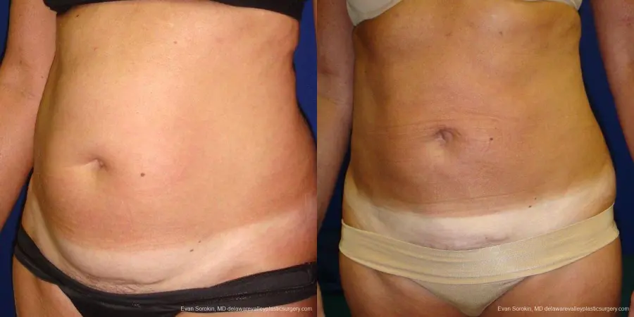 Philadelphia Liposuction 9488 - Before and After 2
