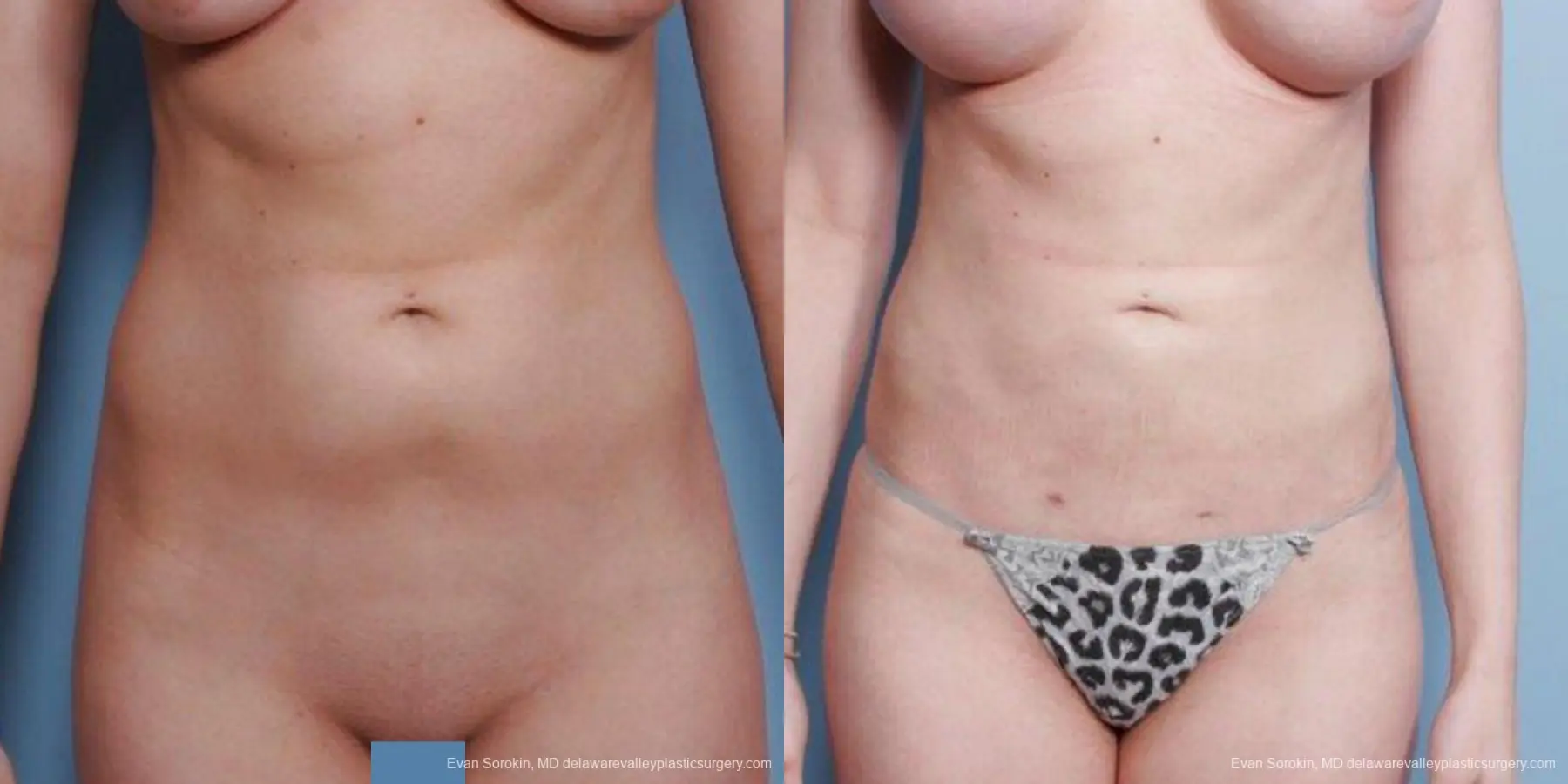 Philadelphia Liposuction 9482 - Before and After