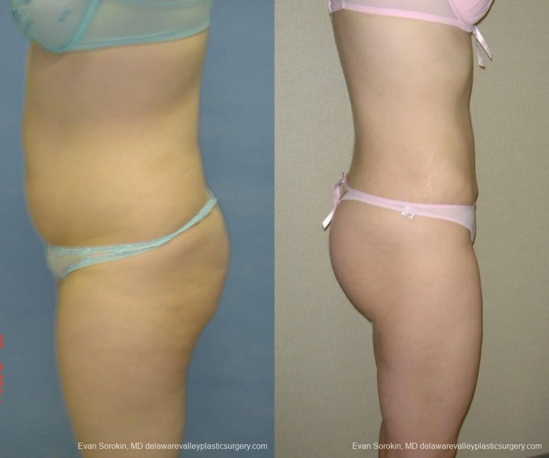 Philadelphia Liposuction 9480 - Before and After 3