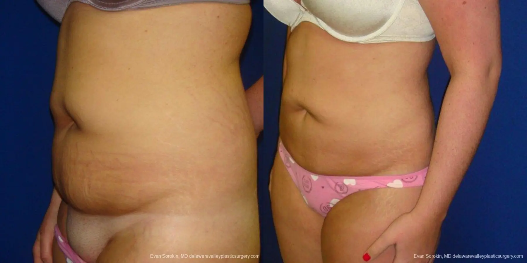 Philadelphia Liposuction 9484 - Before and After 3