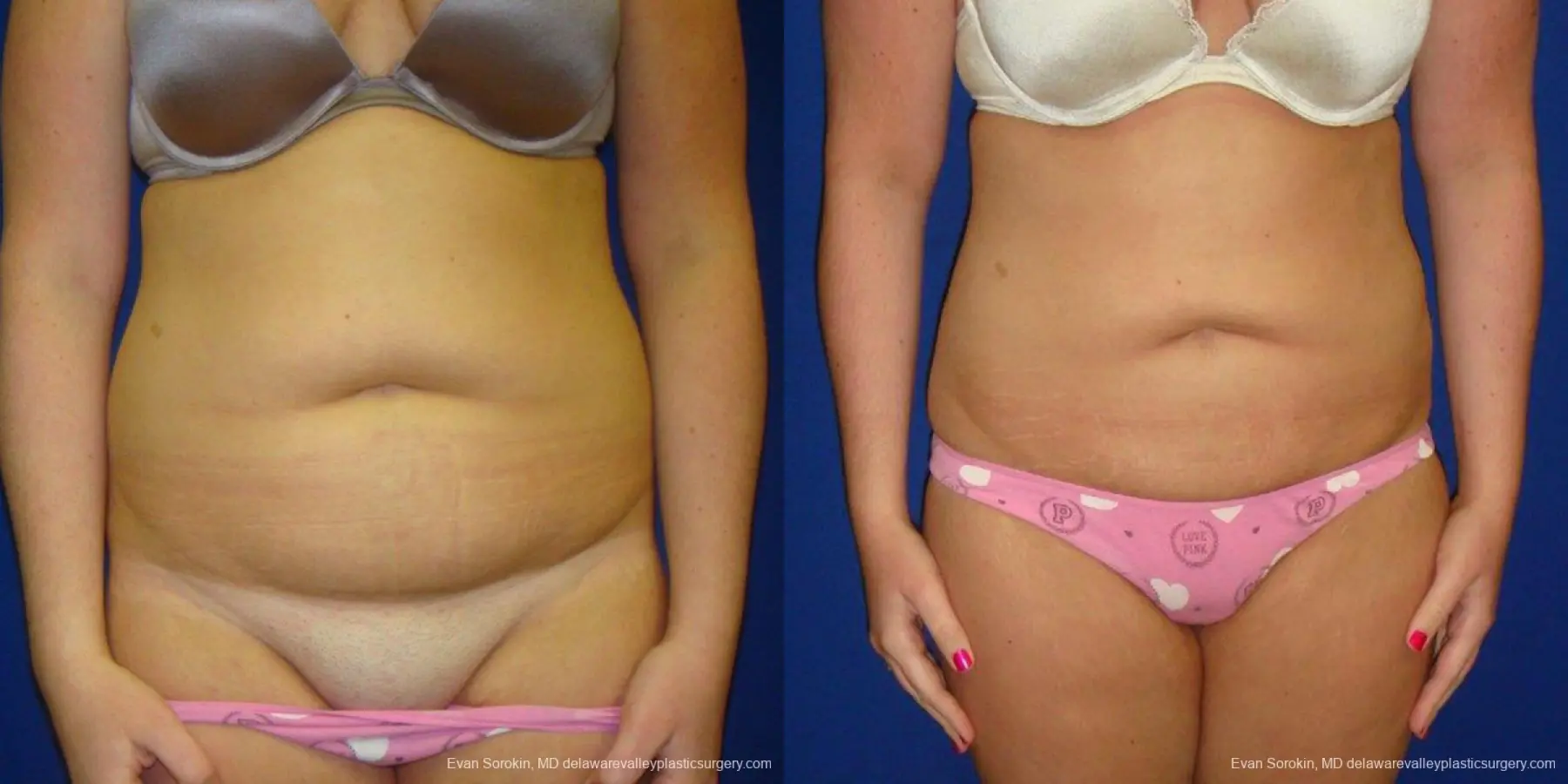 Philadelphia Liposuction 9484 - Before and After 1